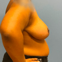 Breast Reduction