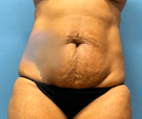 Tummy Tuck