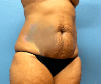 Tummy Tuck