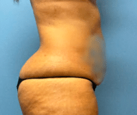 Tummy Tuck