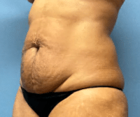 Tummy Tuck