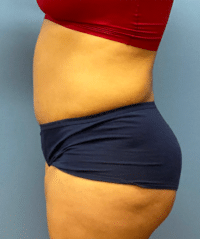 Tummy Tuck