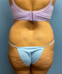 Tummy Tuck