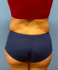 Tummy Tuck