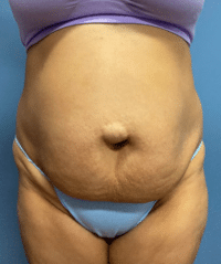 Tummy Tuck