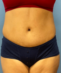 Tummy Tuck