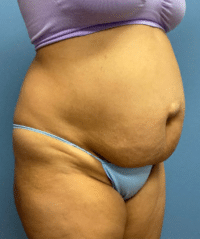 Tummy Tuck