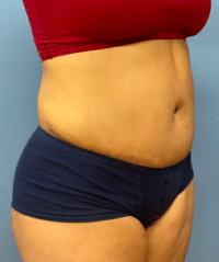 Tummy Tuck