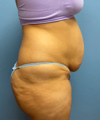 Tummy Tuck