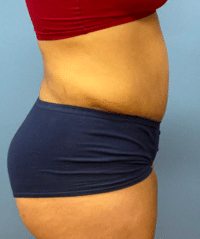 Tummy Tuck