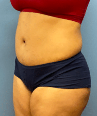 Tummy Tuck