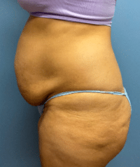 Tummy Tuck