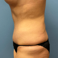 Tummy Tuck