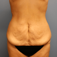 Tummy Tuck