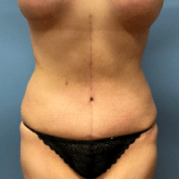 Tummy Tuck