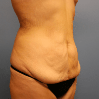 Tummy Tuck