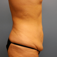 Tummy Tuck