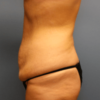 Tummy Tuck