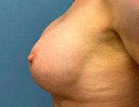 Breast Augmentation