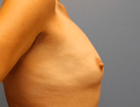 Breast Augmentation