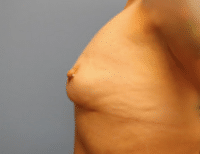 Breast Augmentation