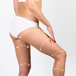 Cellulite removal scheme on body girl
