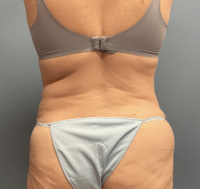 Tummy Tuck