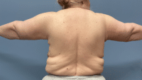 Arm Lift