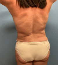 Tummy Tuck