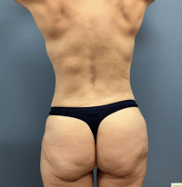 Tummy Tuck