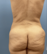 Tummy Tuck