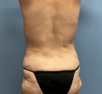Tummy Tuck