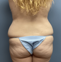 Tummy Tuck