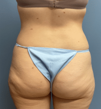 Tummy Tuck