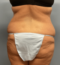 Tummy Tuck