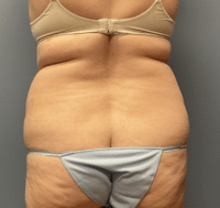 Tummy Tuck