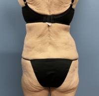 Circumferential Body Lift