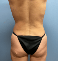 Liposuction