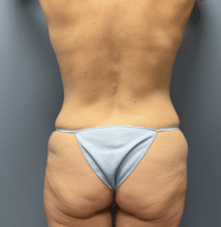 Tummy Tuck