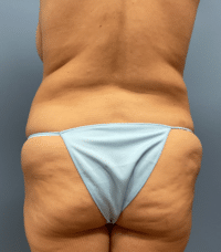 Tummy Tuck