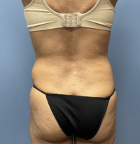 Tummy Tuck