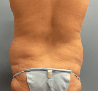 Tummy Tuck