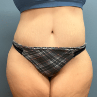 Tummy Tuck