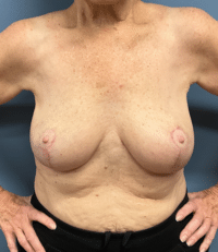 Breast Lift