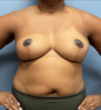 Breast Lift
