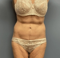 Circumferential Body Lift
