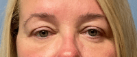 Eyelid Surgery