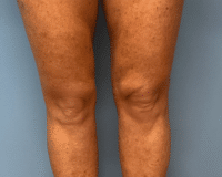 Liposuction