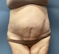 Panniculectomy