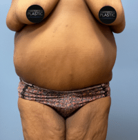 Panniculectomy
